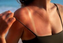 Photo of Izgorjeli ste na suncu? Dermatolozi daju korisne savjete