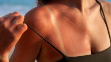 Photo of Izgorjeli ste na suncu? Dermatolozi daju korisne savjete